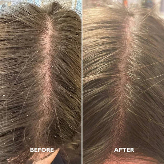 scalp kit before and after